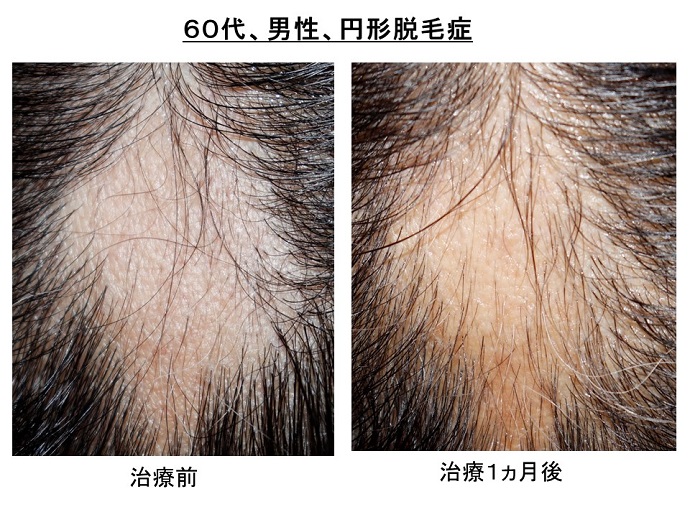 円形脱毛症　病院